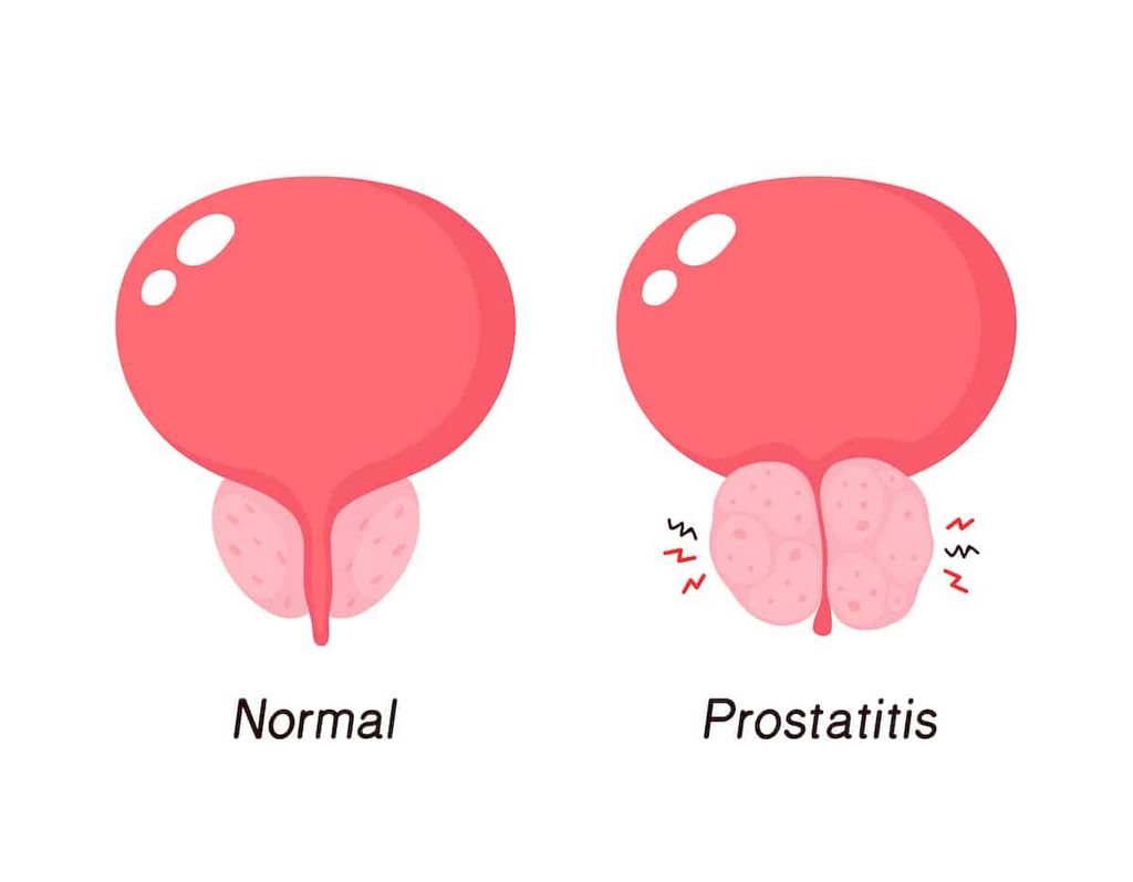 Los métodos más eficaces para tratar la prostatitis